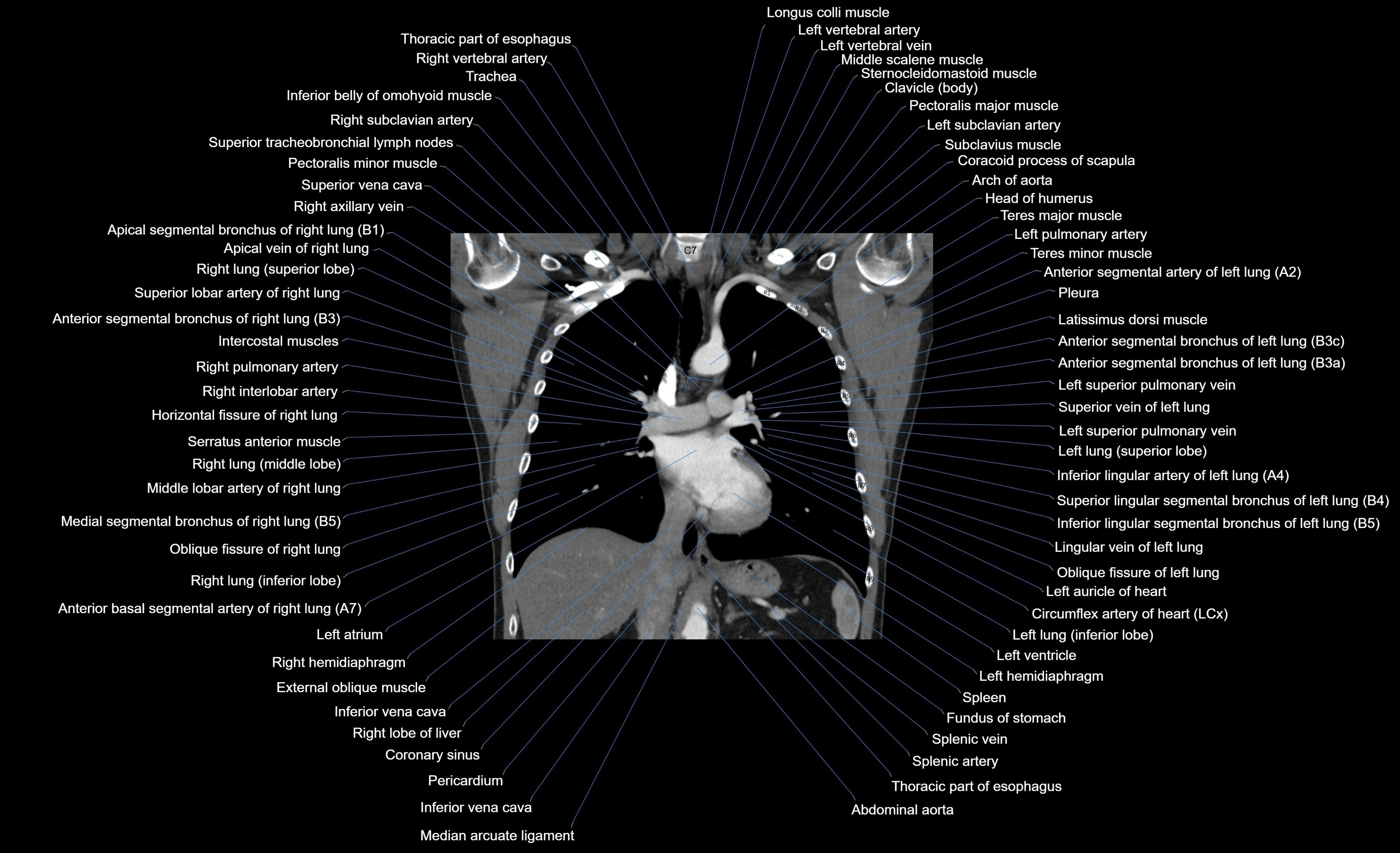 CT chest (thorax) soft tissue window labelled coronal cross sectional anatomy radiology image-00061.webp
